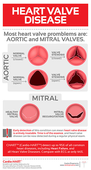 Heart Valve Disease: Aortic and Mitral Heart Valve Disease: Aortic and Mitral