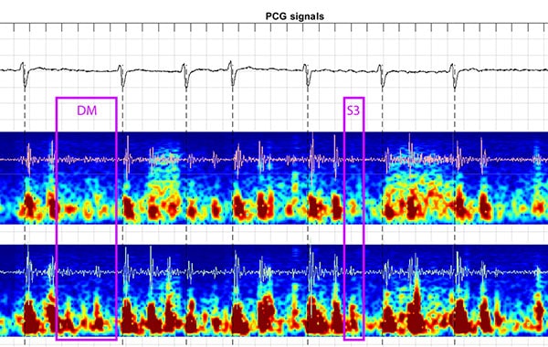 PCG signals - CHART report