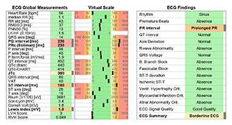 ECG Findings