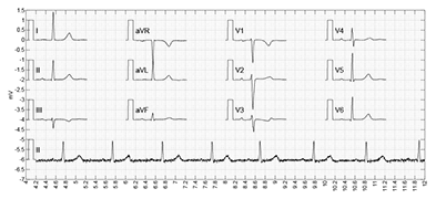 ECG Findings