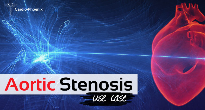 Aortic Stenosis Detected by HART, but Normal ECG Aortic Stenosis Detected by HART, but Normal ECG