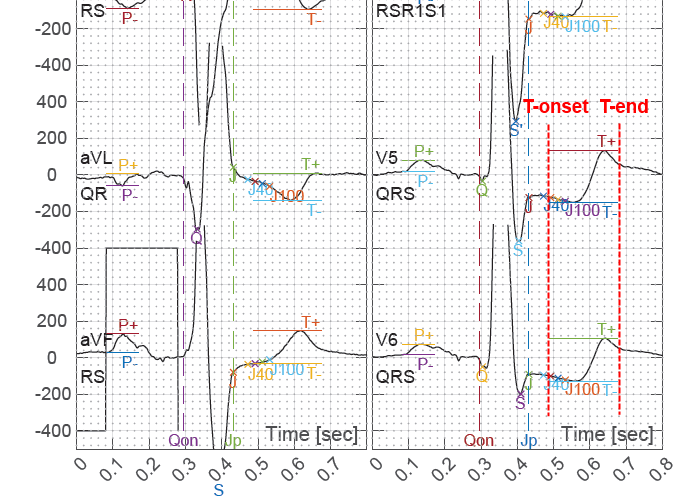 Automatic ECG segmentation in CHART report 