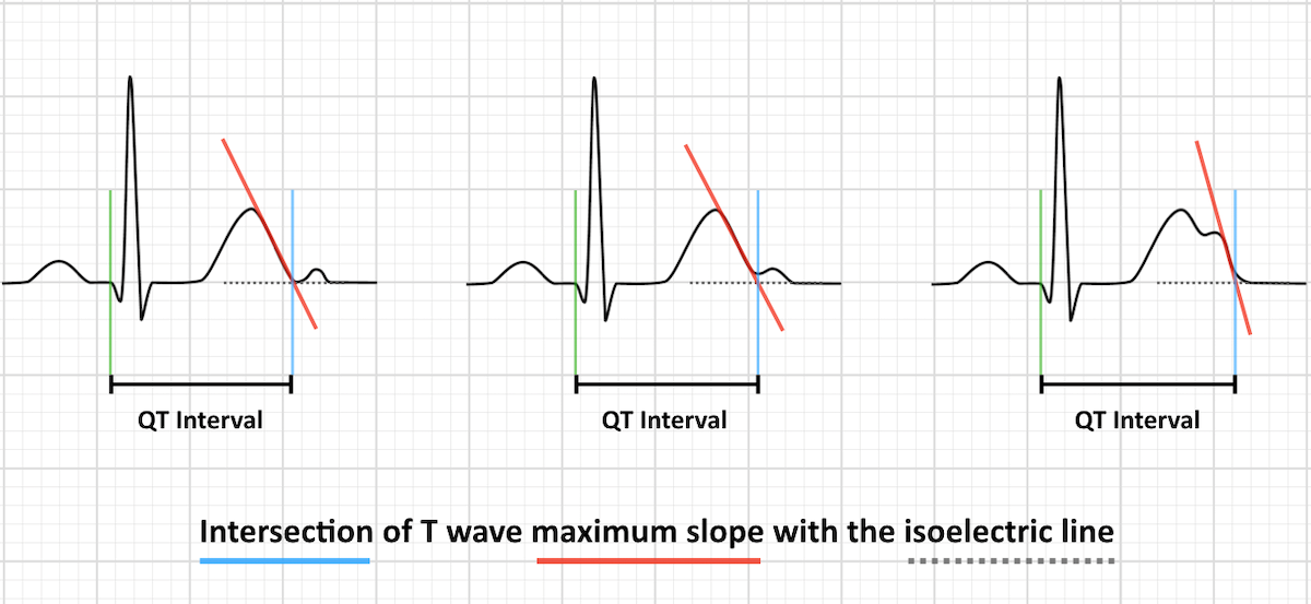 QT interval