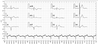 ECG